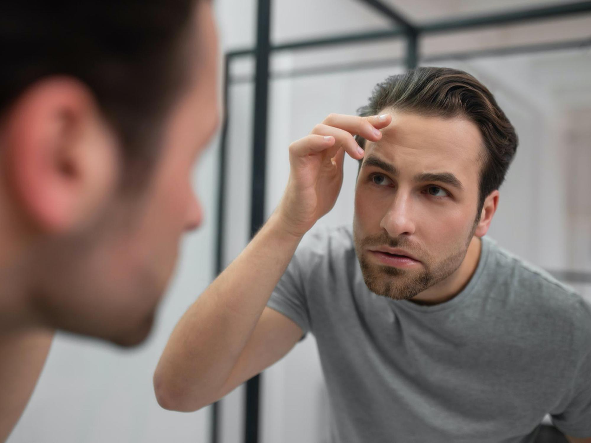 男士年紀愈大患上雄性禿脫髮風險愈高？一文詳解雄性禿的成因與症狀