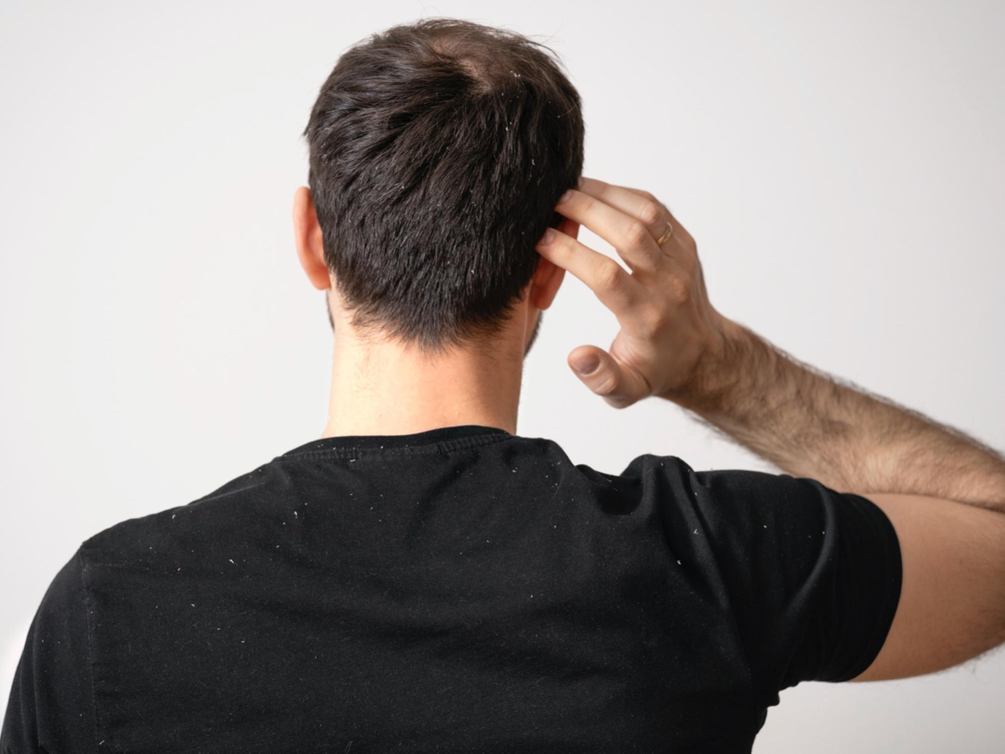 【頭皮發炎】頭皮紅腫痕癢？5大護理方法預防頭皮發炎
