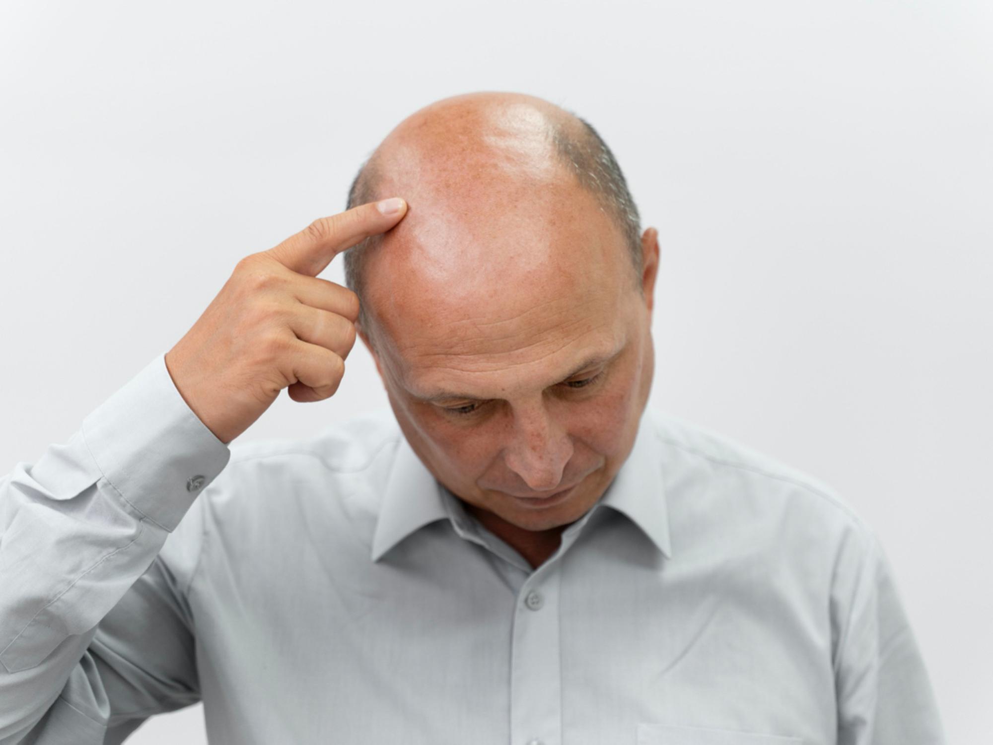 拆解男士脫髮的成因與預防，避免地中海禿頭危機